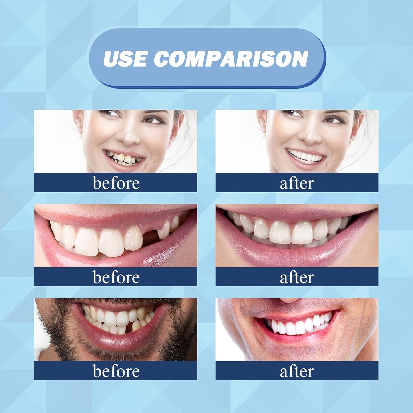 Eelhoe Thermal Forming False Teeth – DIY Temporary Tooth Replacement 🛠️🦷